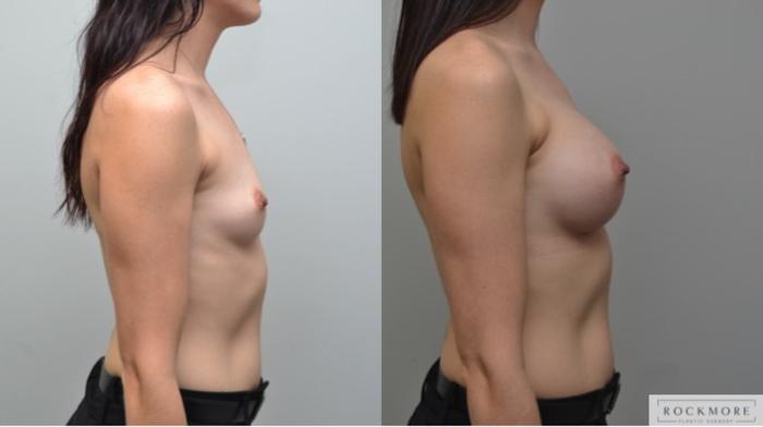 Before & After Breast Augmentation Case 249 View #4 View in Albany & Latham, New York
