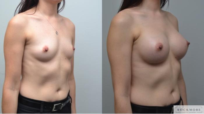Before & After Breast Augmentation Case 249 View #5 View in Albany & Latham, New York