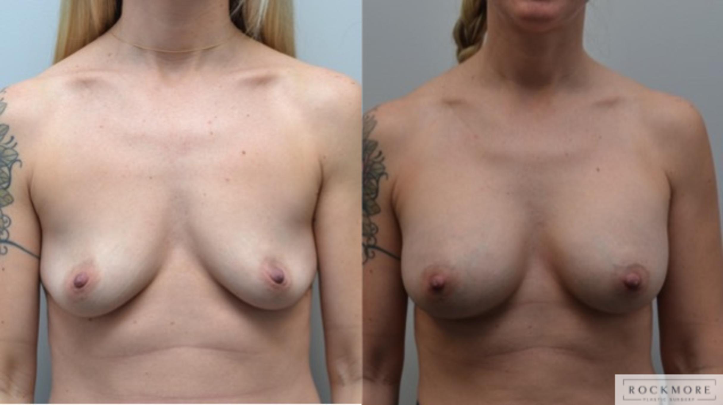 Before & After Breast Augmentation Case 252 View #1 View in Albany & Latham, New York