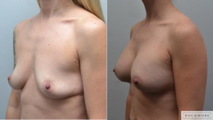 Before & After Breast Augmentation Case 252 View #2 View in Albany & Latham, New York