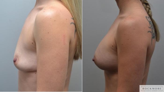 Before & After Breast Augmentation Case 252 View #3 View in Albany & Latham, New York
