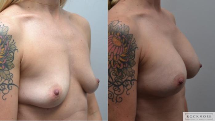 Before & After Breast Augmentation Case 252 View #4 View in Albany & Latham, New York