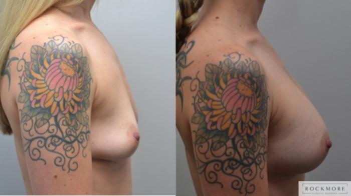 Before & After Breast Augmentation Case 252 View #5 View in Albany & Latham, New York