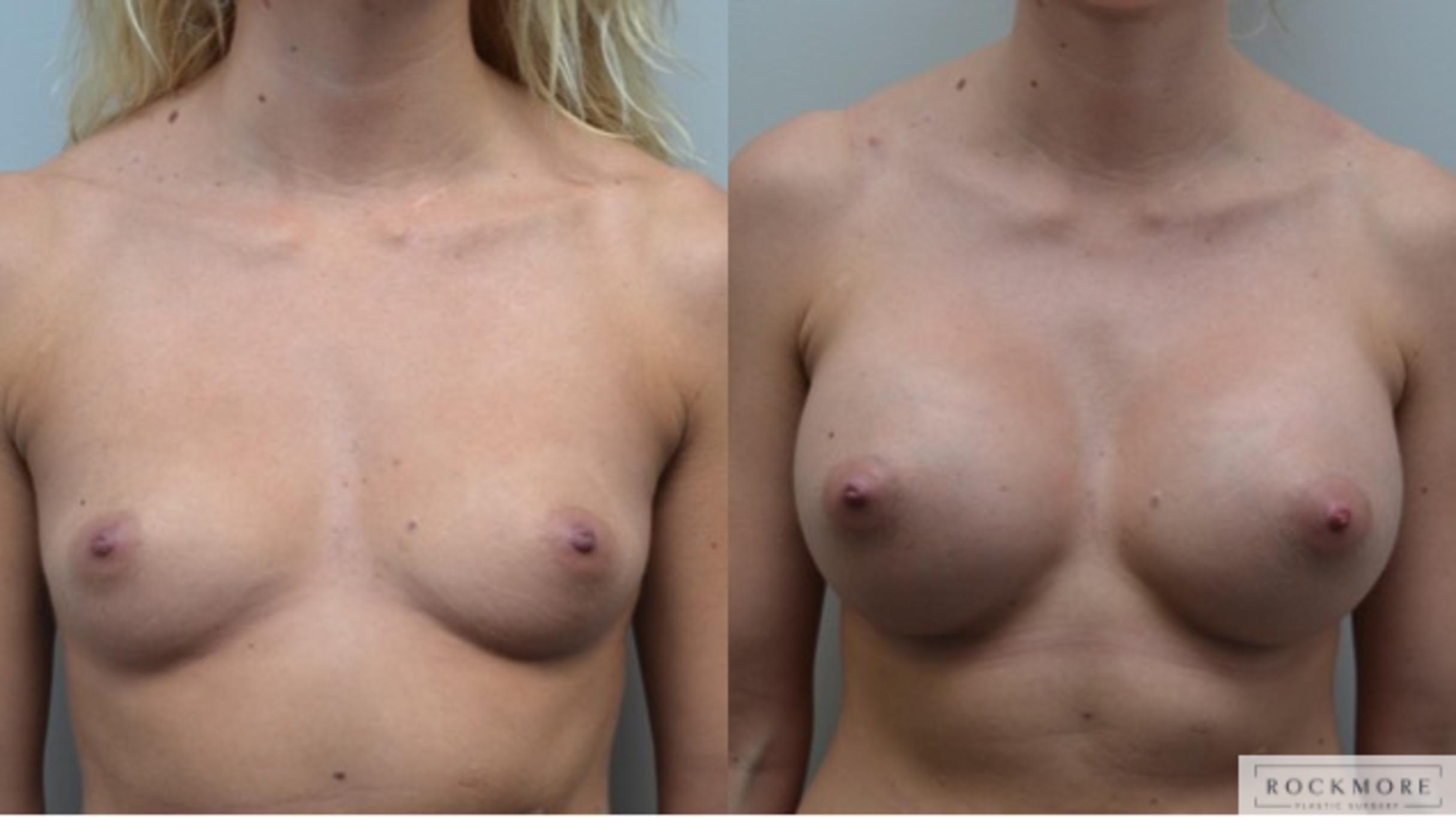 Before & After Breast Augmentation Case 255 View #1 View in Albany & Latham, New York