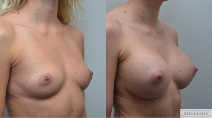 Before & After Breast Augmentation Case 255 View #2 View in Albany & Latham, New York