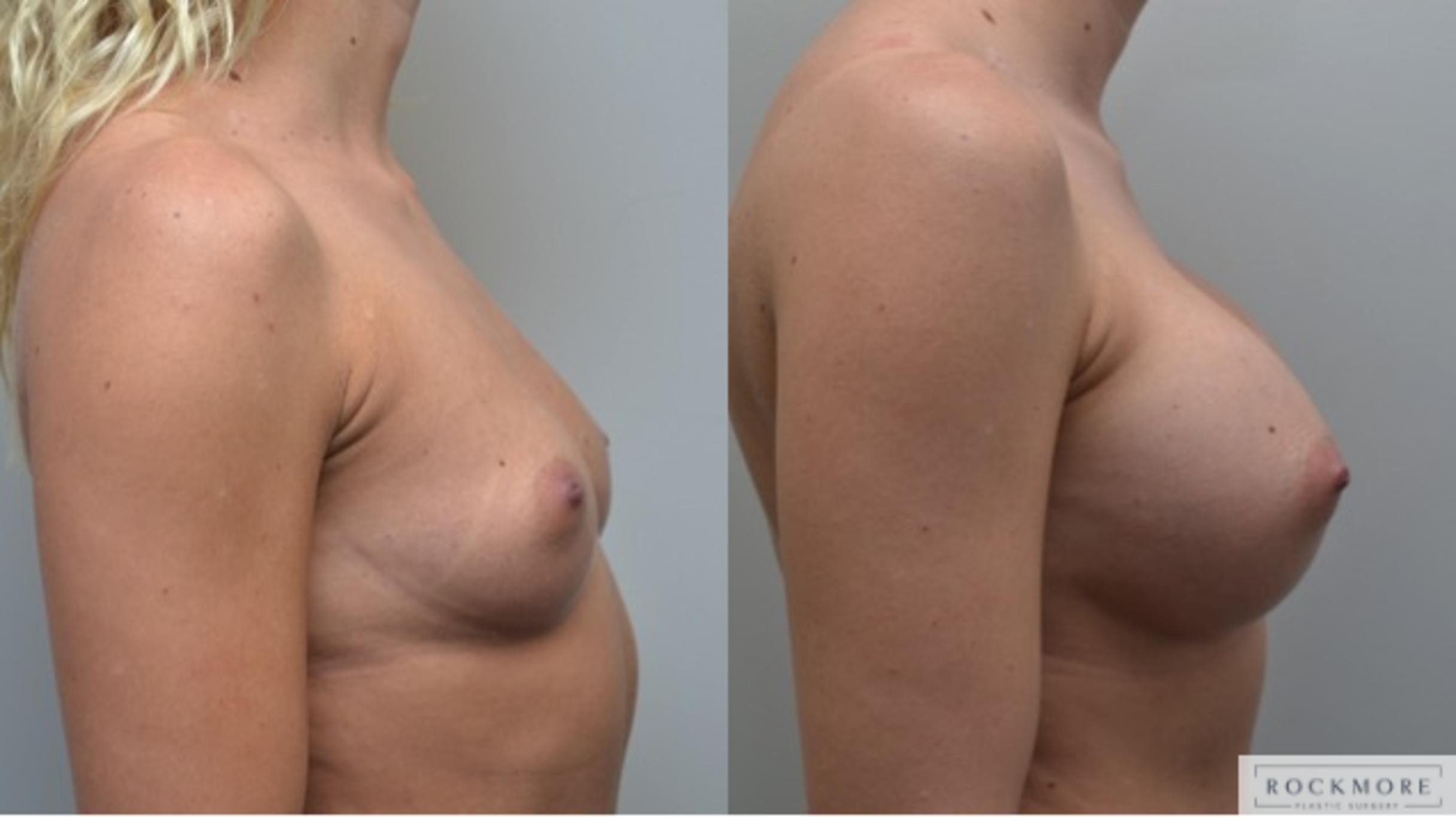 Before & After Breast Augmentation Case 255 View #3 View in Albany & Latham, New York