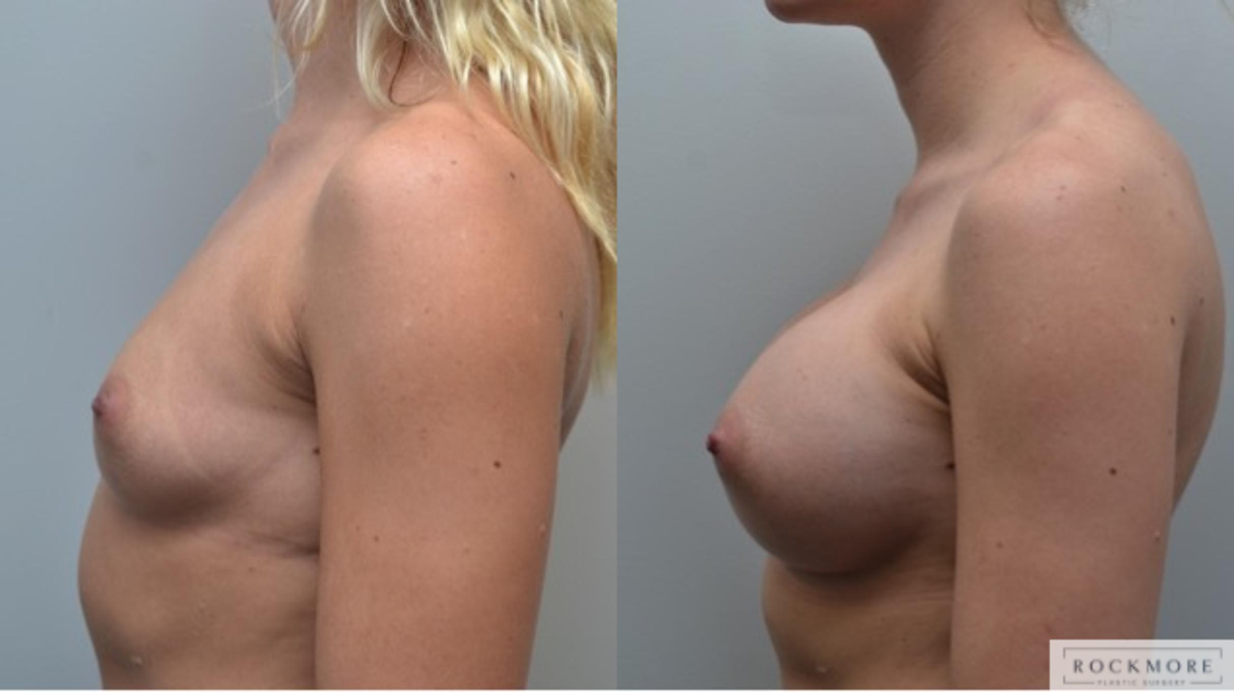 Before & After Breast Augmentation Case 255 View #4 View in Albany & Latham, New York