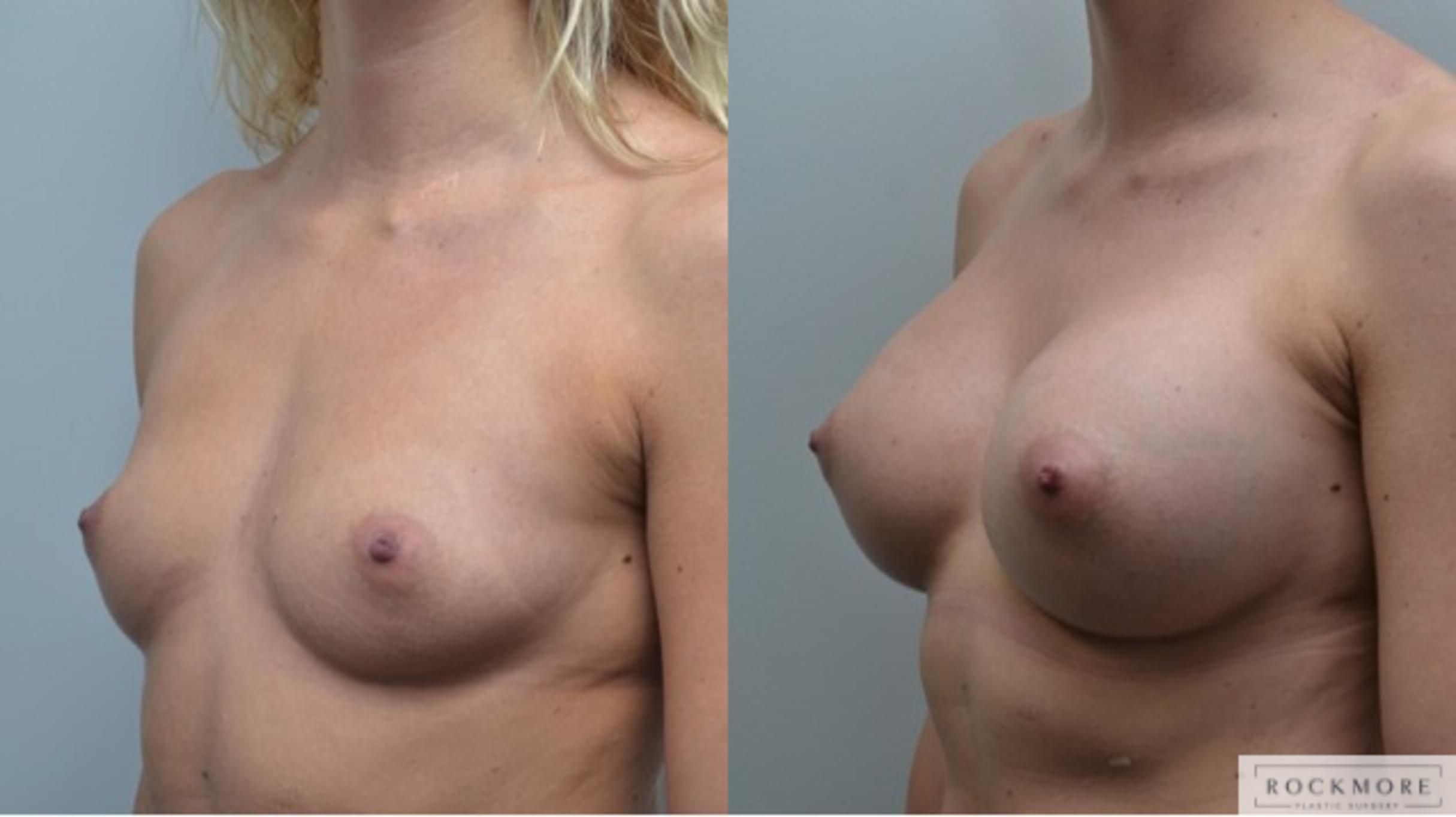 Before & After Breast Augmentation Case 255 View #5 View in Albany & Latham, New York