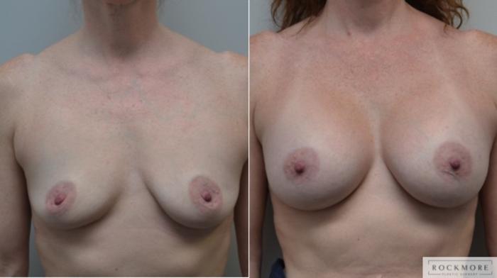 Before & After Breast Augmentation Case 256 View #1 View in Albany & Latham, New York