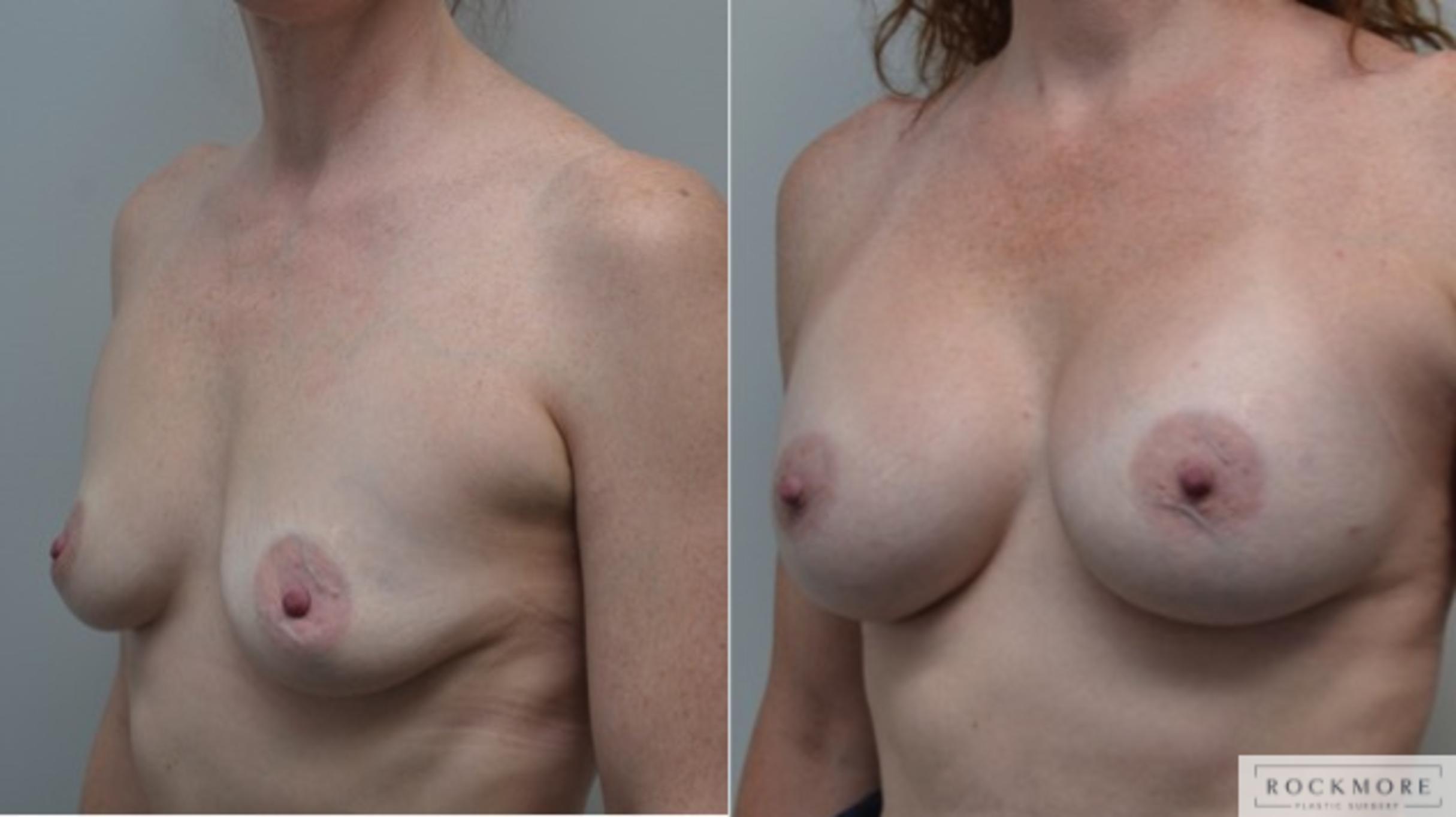 Before & After Breast Augmentation Case 256 View #2 View in Albany & Latham, New York