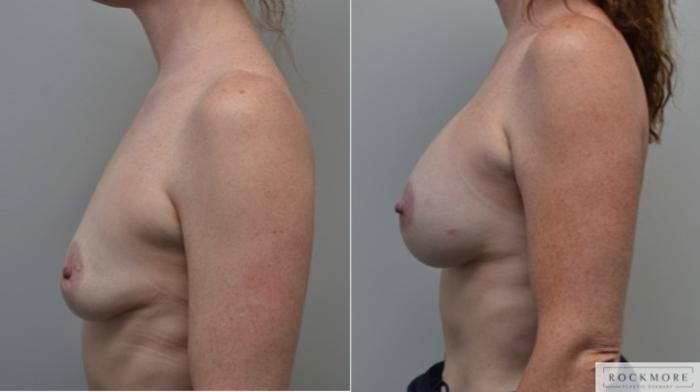 Before & After Breast Augmentation Case 256 View #3 View in Albany & Latham, New York
