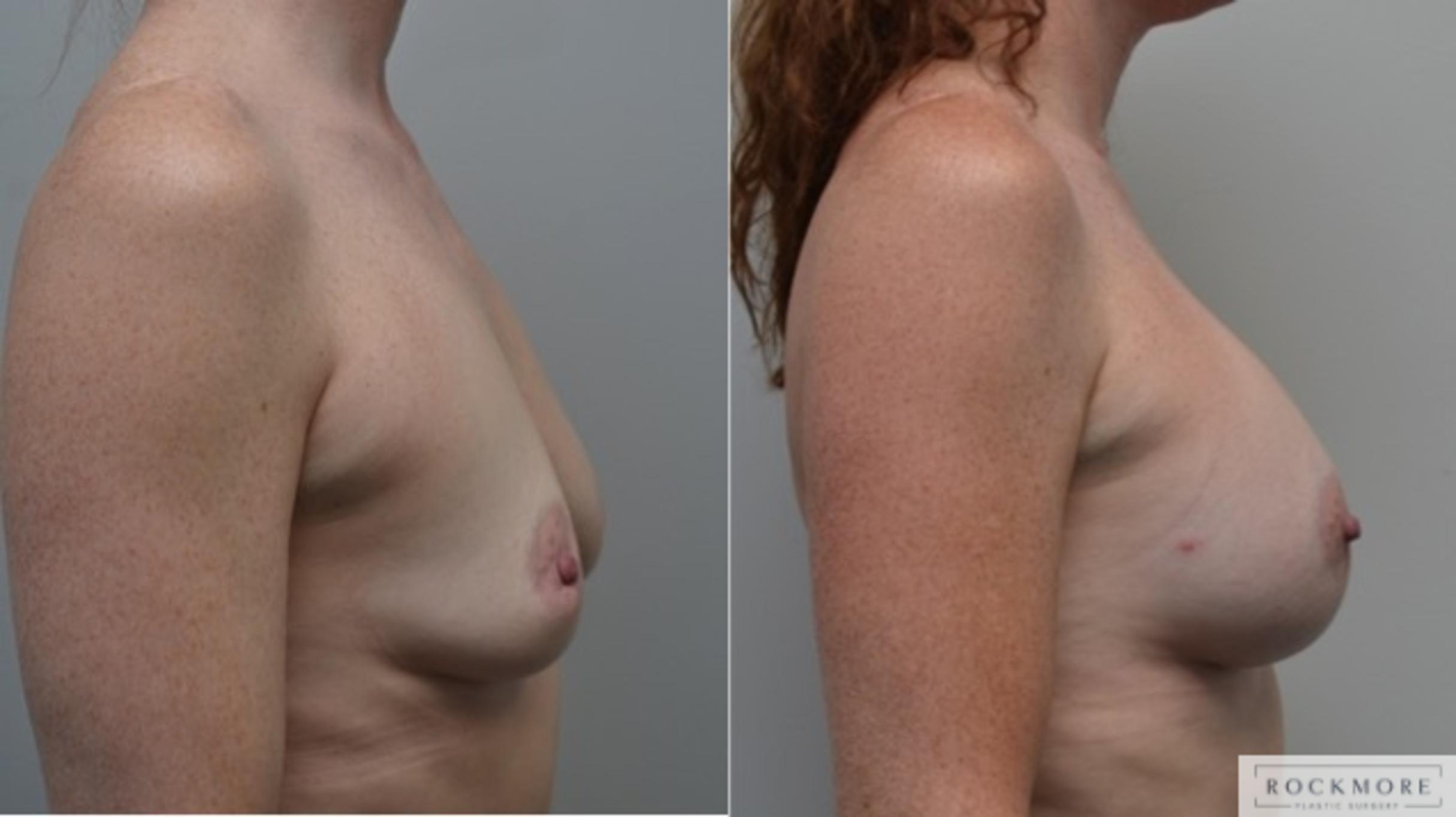 Before & After Breast Augmentation Case 256 View #4 View in Albany & Latham, New York