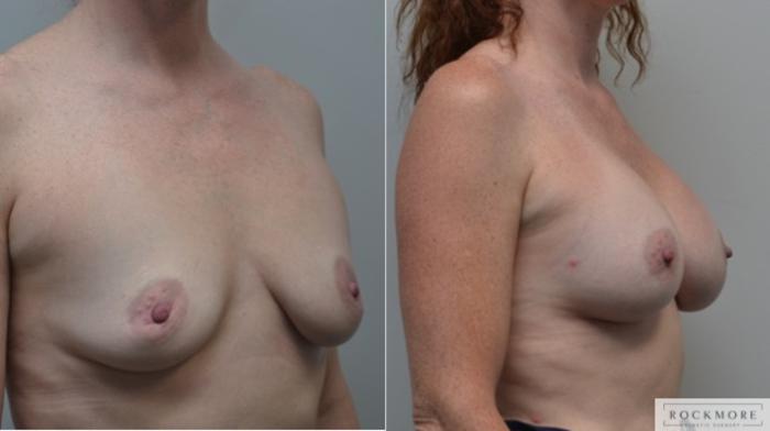Before & After Breast Augmentation Case 256 View #5 View in Albany & Latham, New York