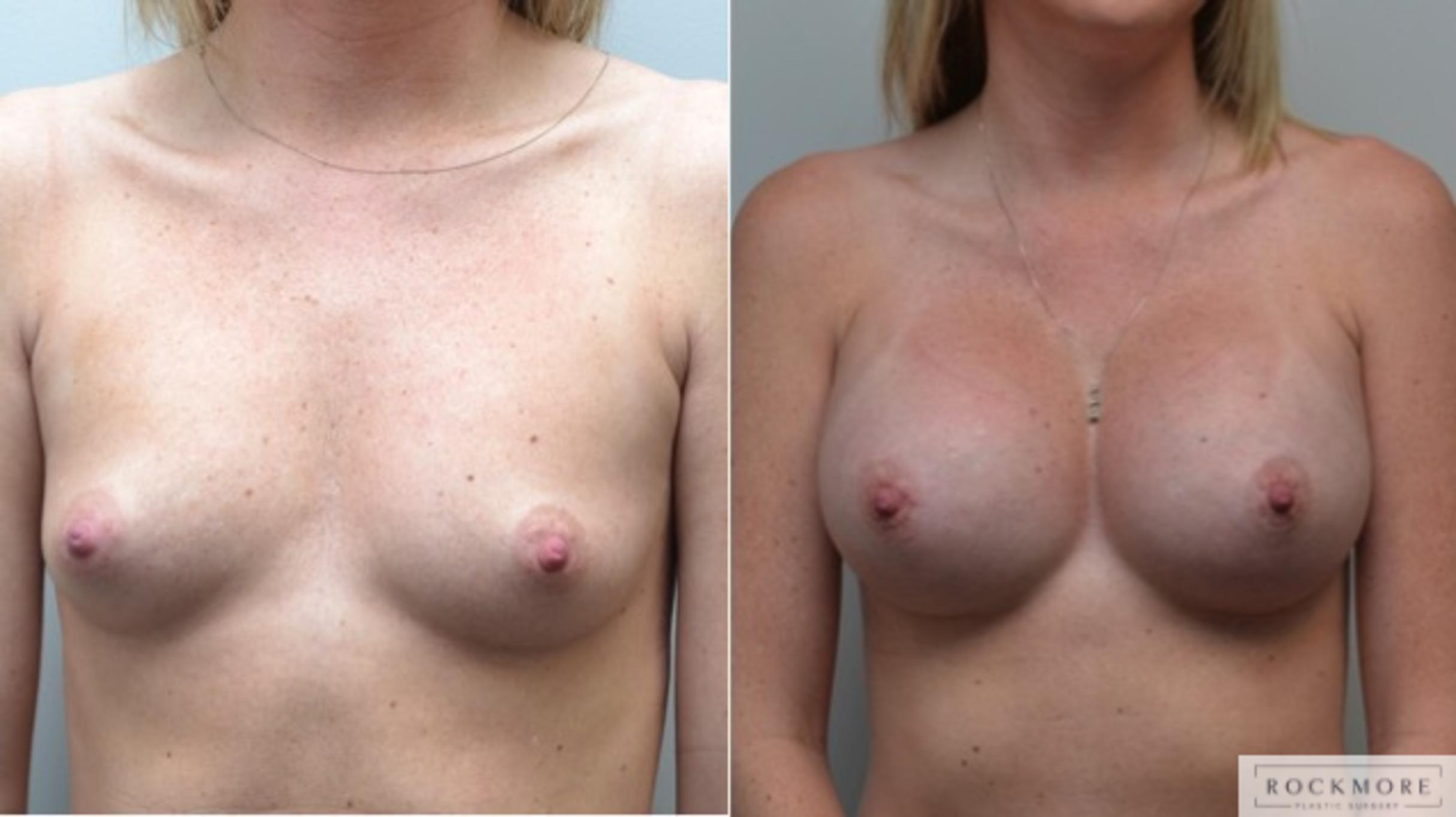 Before & After Breast Augmentation Case 257 View #1 View in Albany & Latham, New York