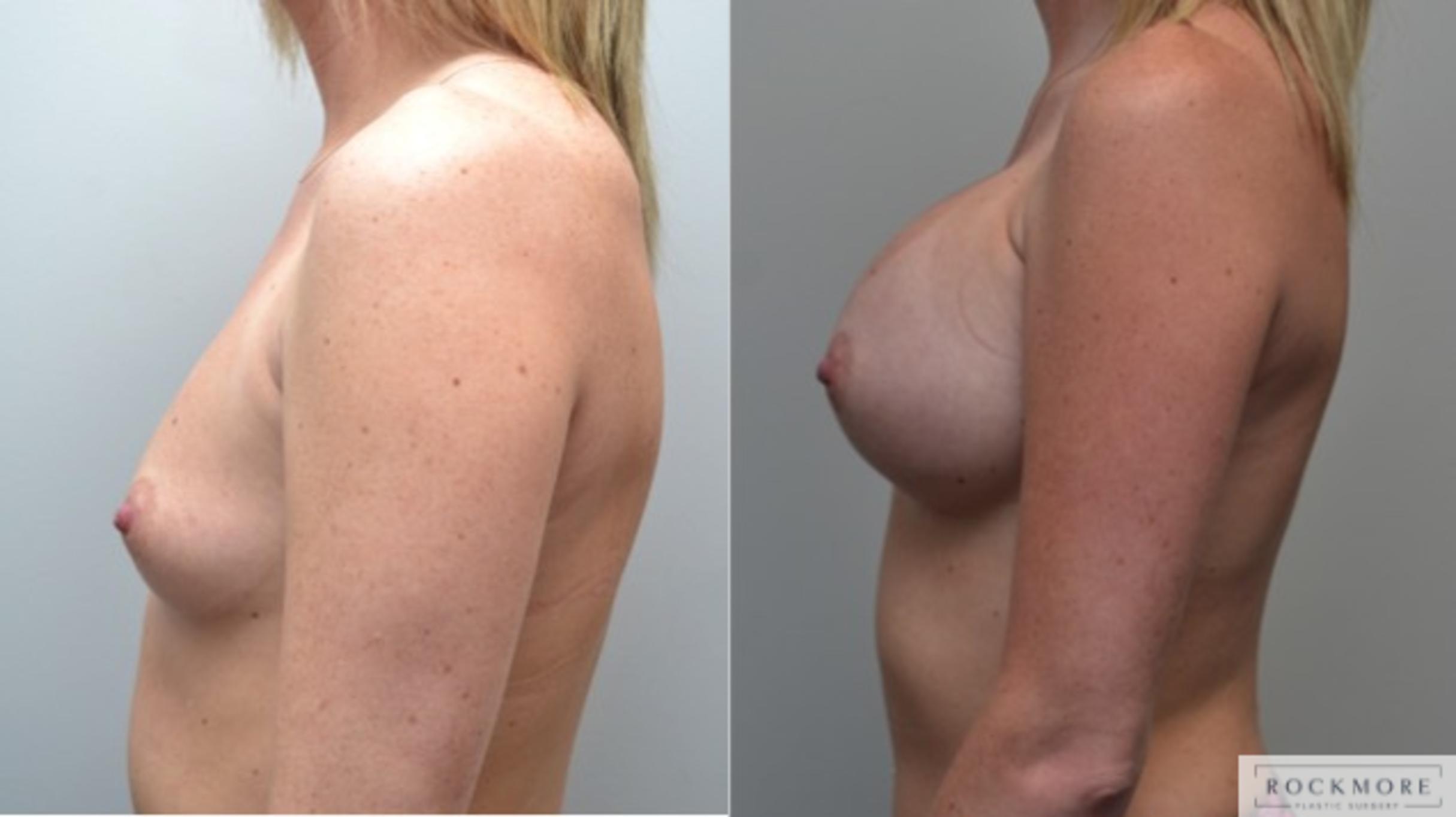 Before & After Breast Augmentation Case 257 View #2 View in Albany & Latham, New York