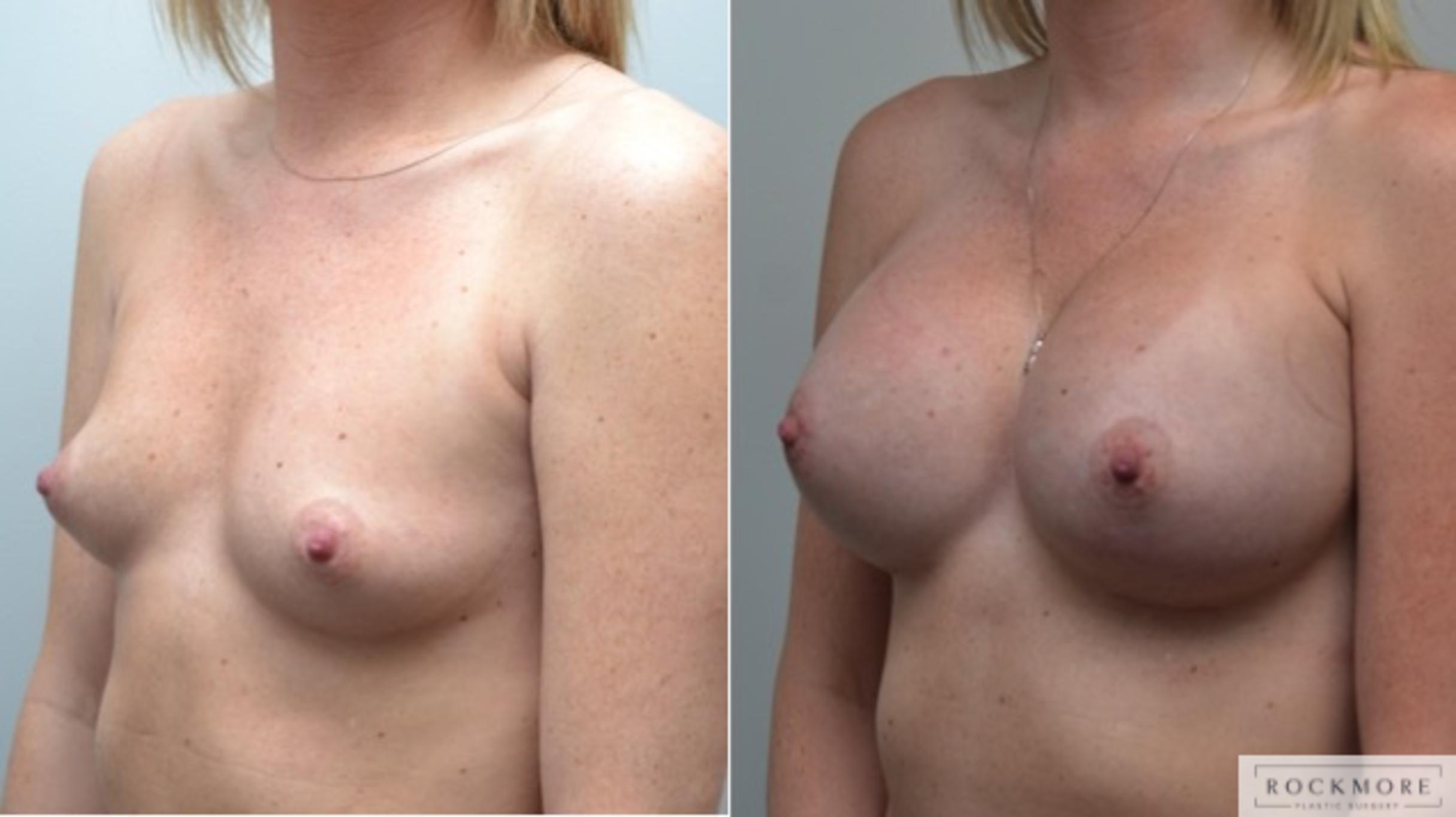 Before & After Breast Augmentation Case 257 View #3 View in Albany & Latham, New York