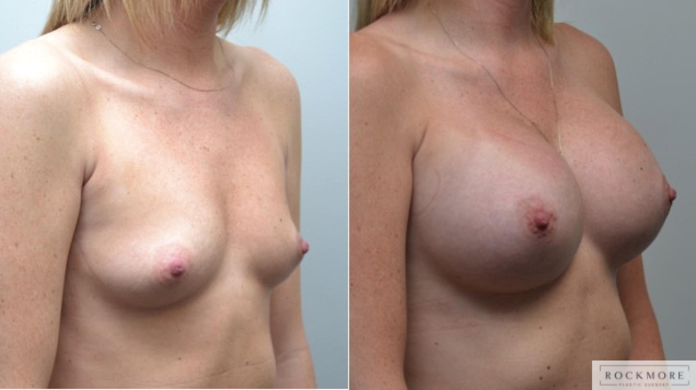 Before & After Breast Augmentation Case 257 View #4 View in Albany & Latham, New York