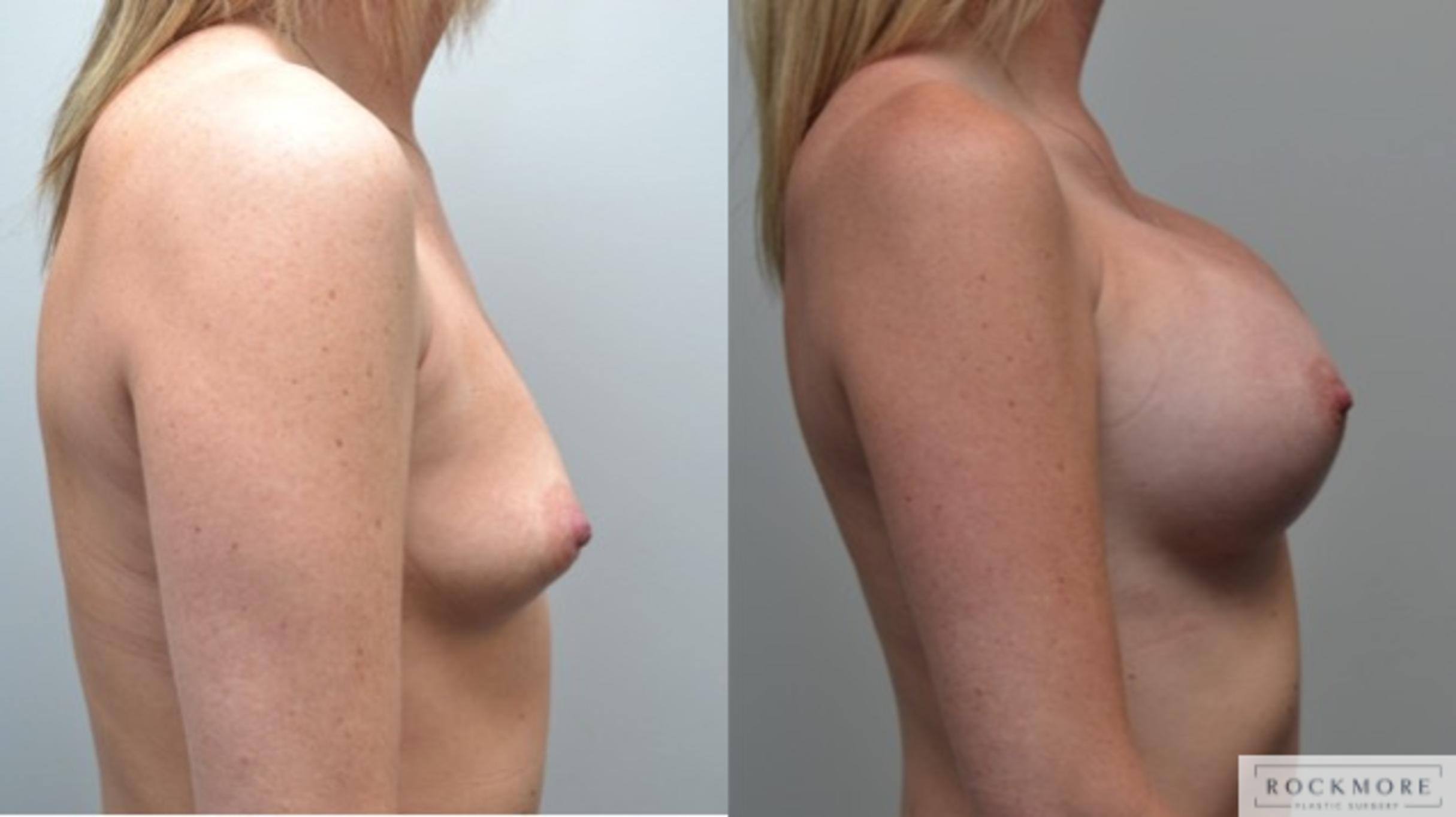 Before & After Breast Augmentation Case 257 View #5 View in Albany & Latham, New York