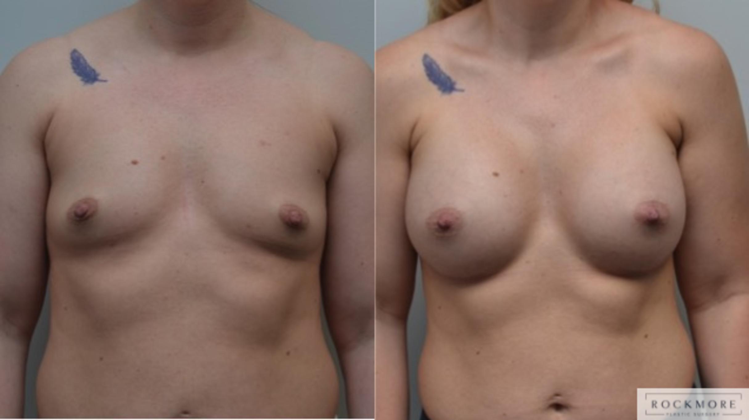 Before & After Breast Augmentation Case 259 View #1 View in Albany & Latham, New York