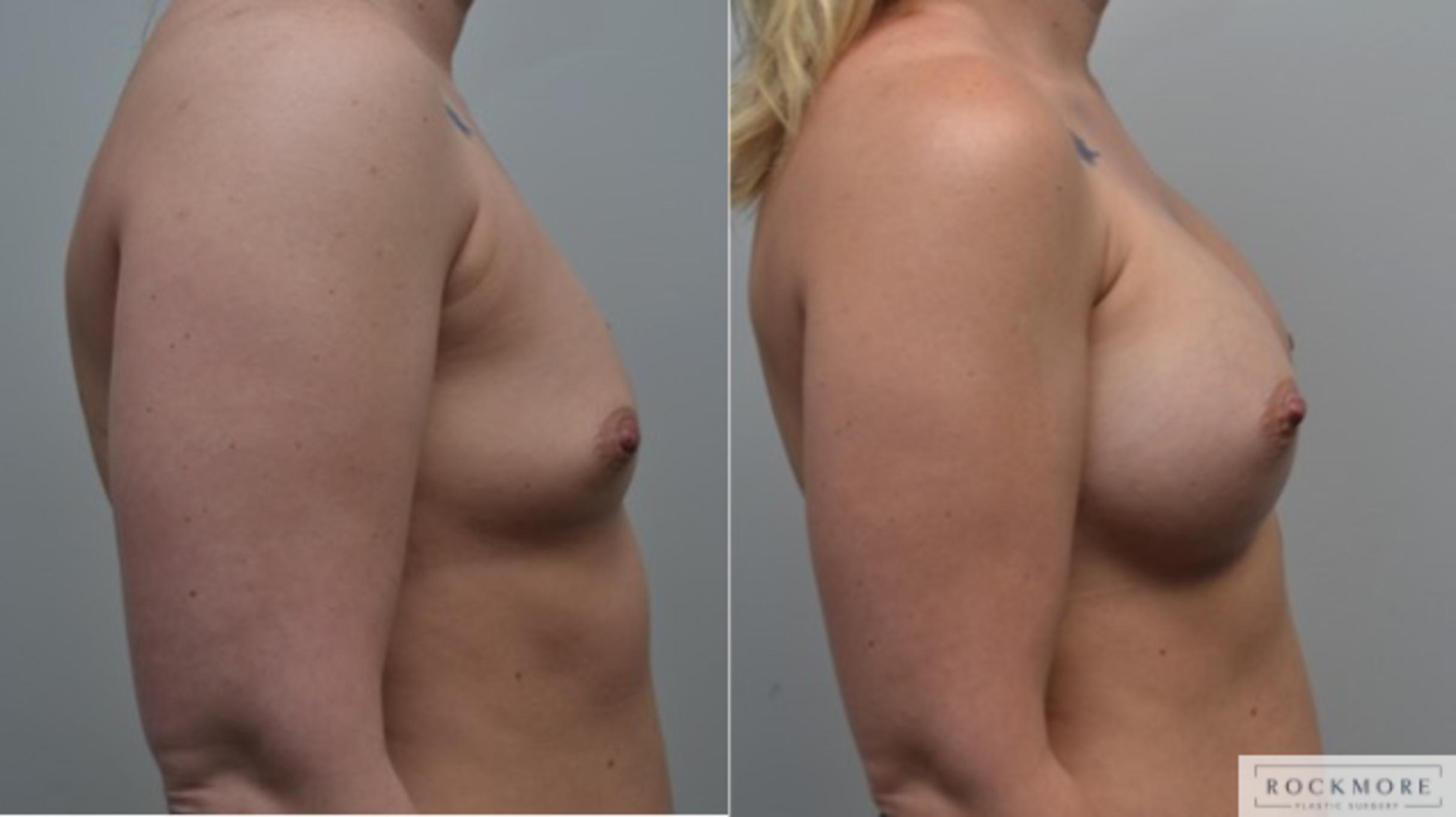 Before & After Breast Augmentation Case 259 View #2 View in Albany & Latham, New York