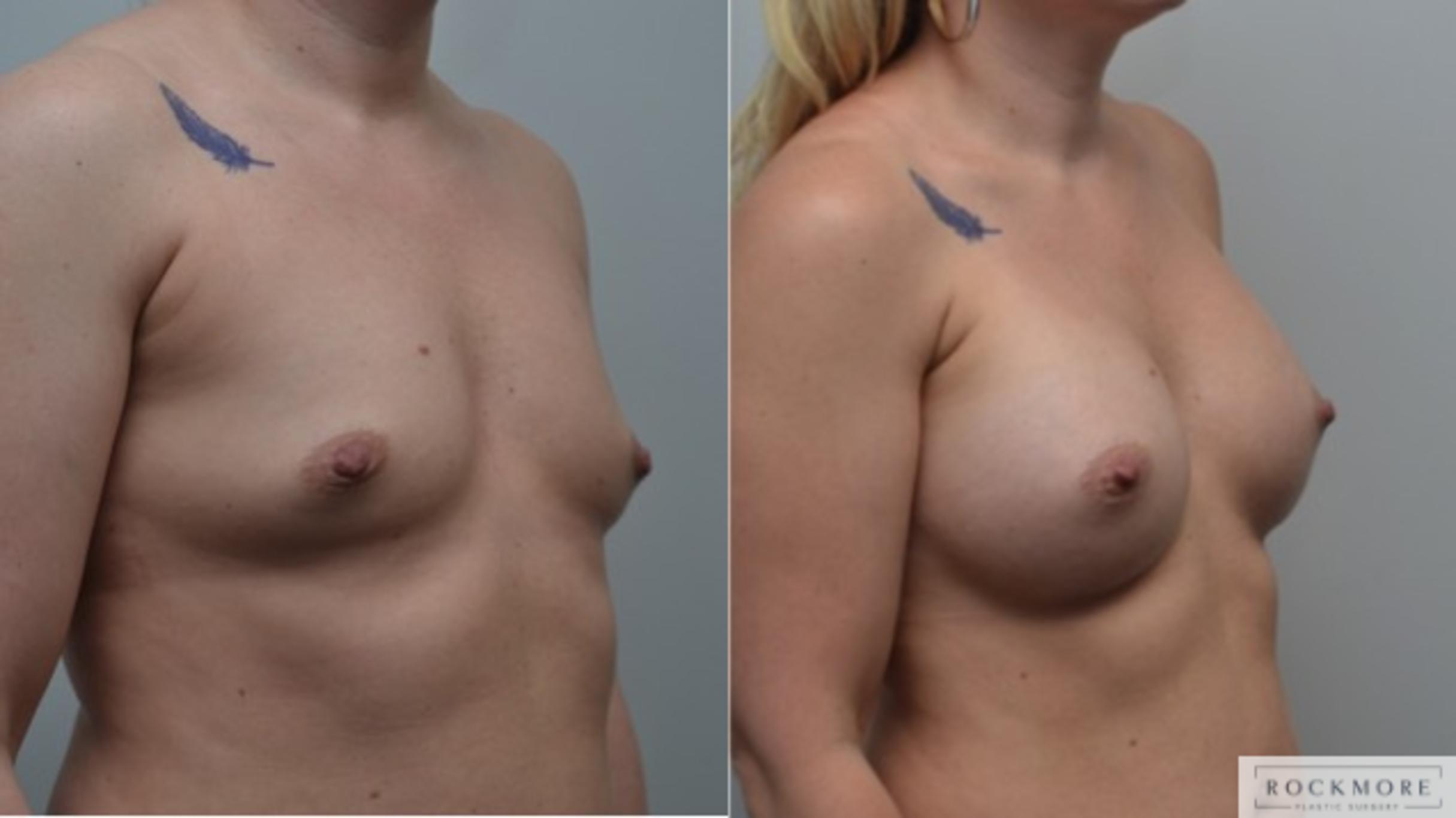Before & After Breast Augmentation Case 259 View #3 View in Albany & Latham, New York