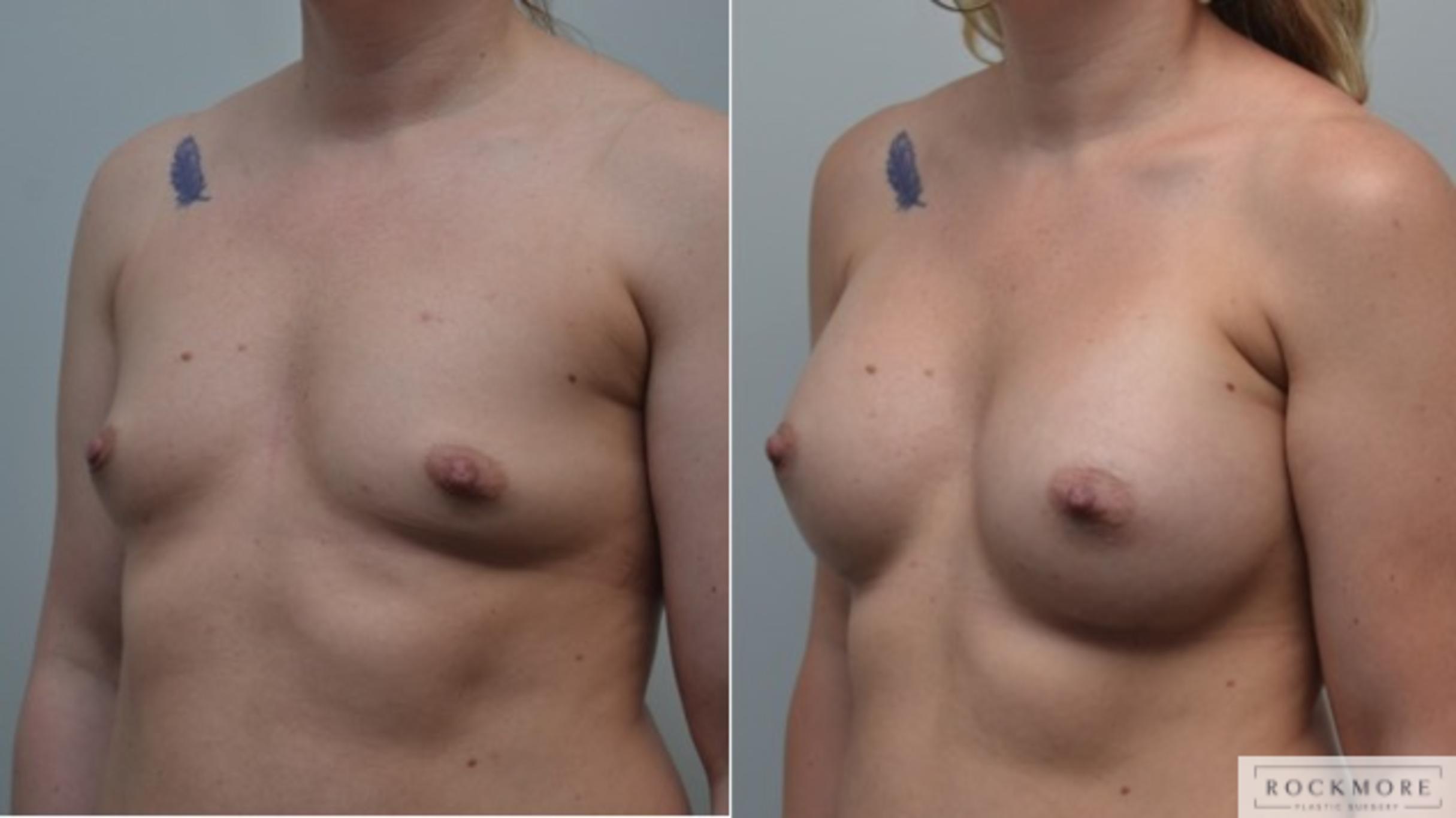 Before & After Breast Augmentation Case 259 View #4 View in Albany & Latham, New York