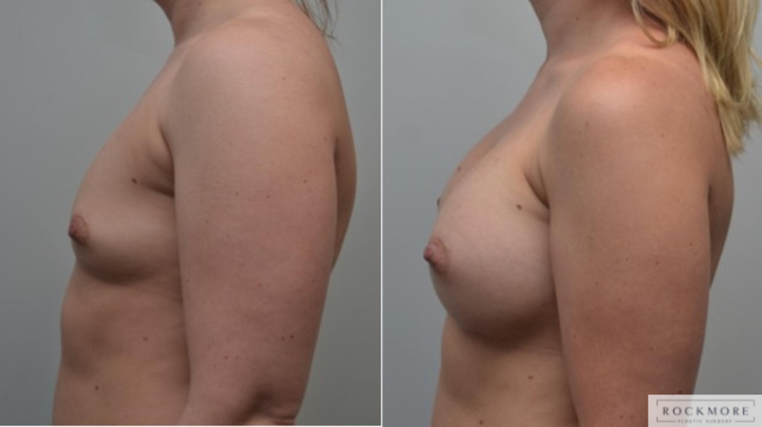 Before & After Breast Augmentation Case 259 View #5 View in Albany & Latham, New York