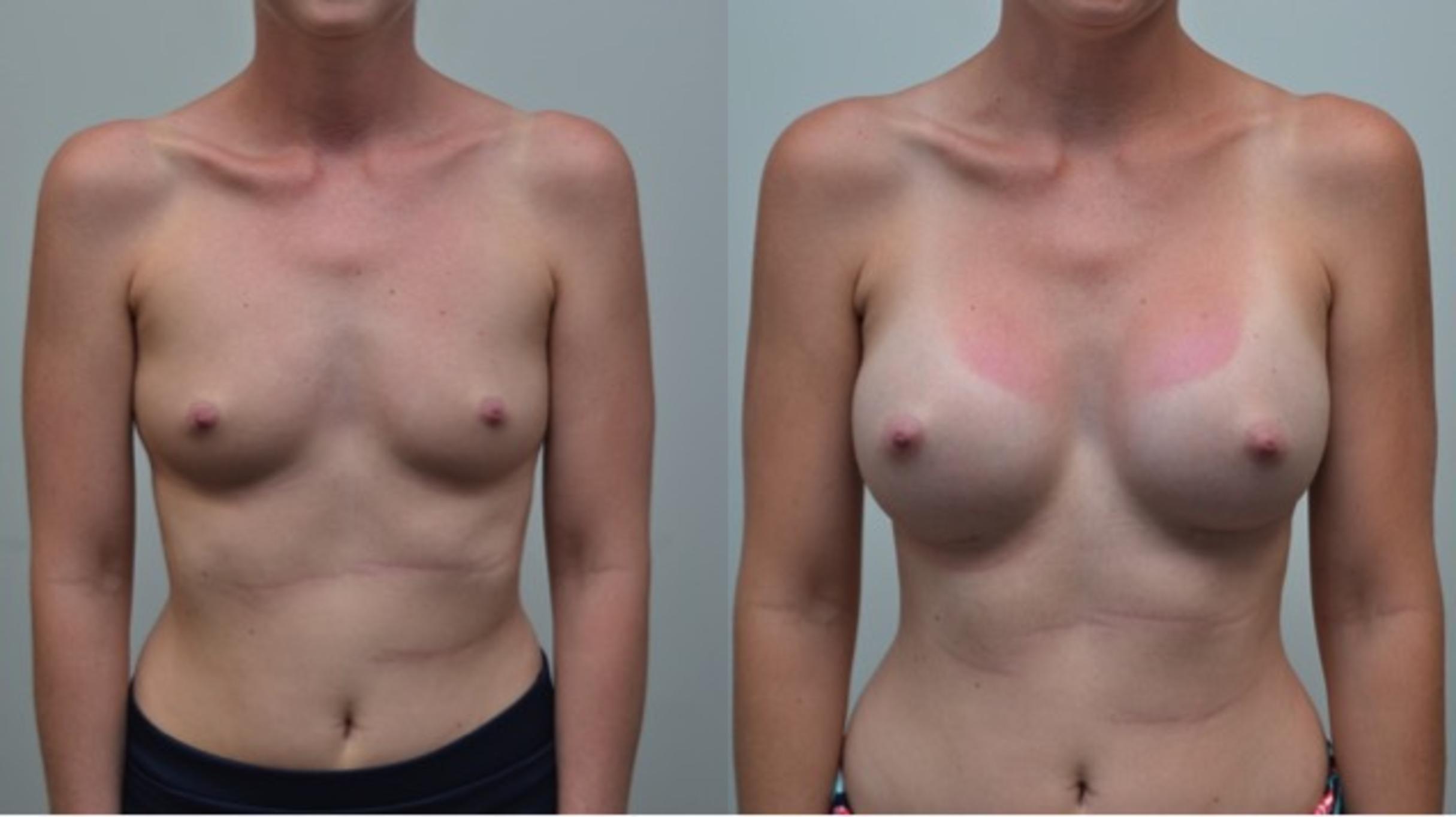 Before & After Breast Augmentation Case 263 View #1 View in Albany & Latham, New York