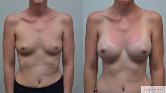 Before & After Breast Augmentation Case 263 View #1 View in Albany & Latham, New York