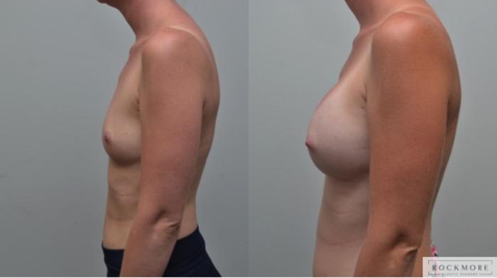 Before & After Breast Augmentation Case 263 View #2 View in Albany & Latham, New York