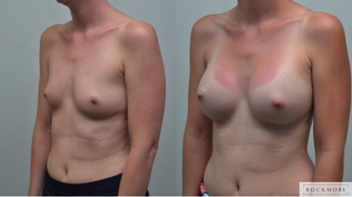Before & After Breast Augmentation Case 263 View #3 View in Albany & Latham, New York