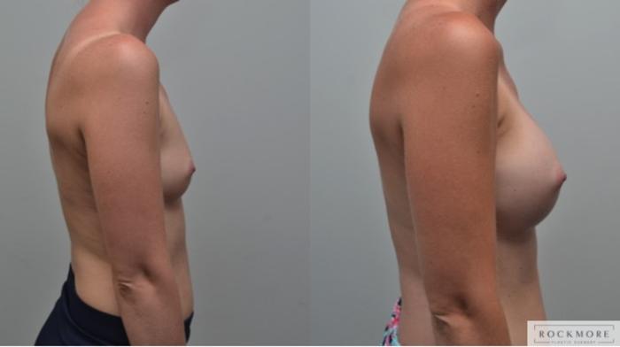 Before & After Breast Augmentation Case 263 View #4 View in Albany & Latham, New York