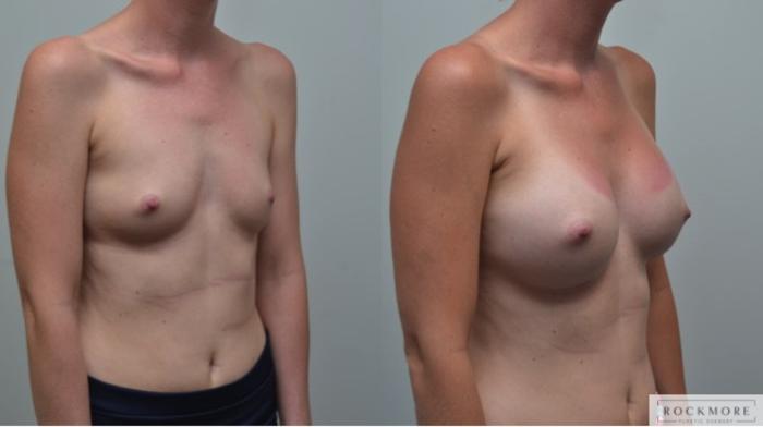 Before & After Breast Augmentation Case 263 View #5 View in Albany & Latham, New York