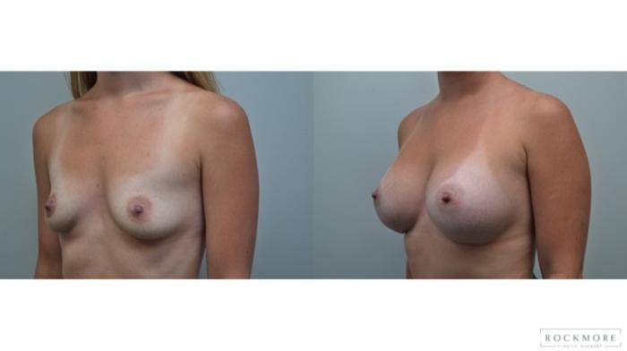 Before & After Breast Augmentation Case 264 View #2 View in Albany & Latham, New York