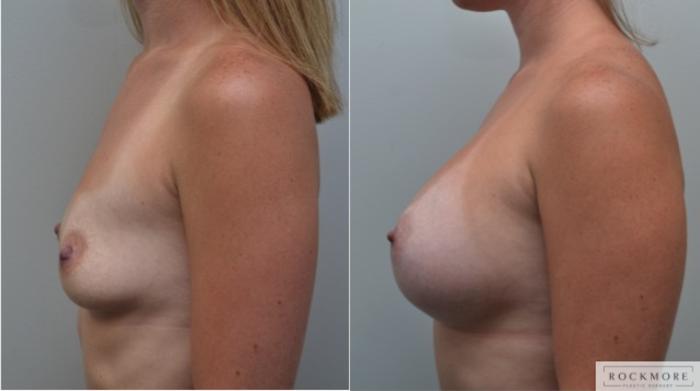 Before & After Breast Augmentation Case 264 View #3 View in Albany & Latham, New York