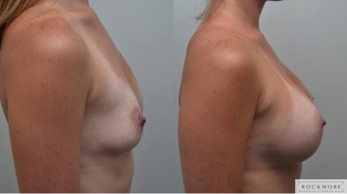 Before & After Breast Augmentation Case 264 View #4 View in Albany & Latham, New York