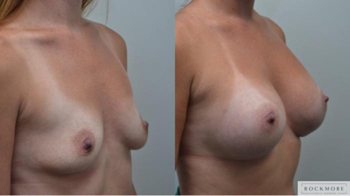 Before & After Breast Augmentation Case 264 View #5 View in Albany & Latham, New York