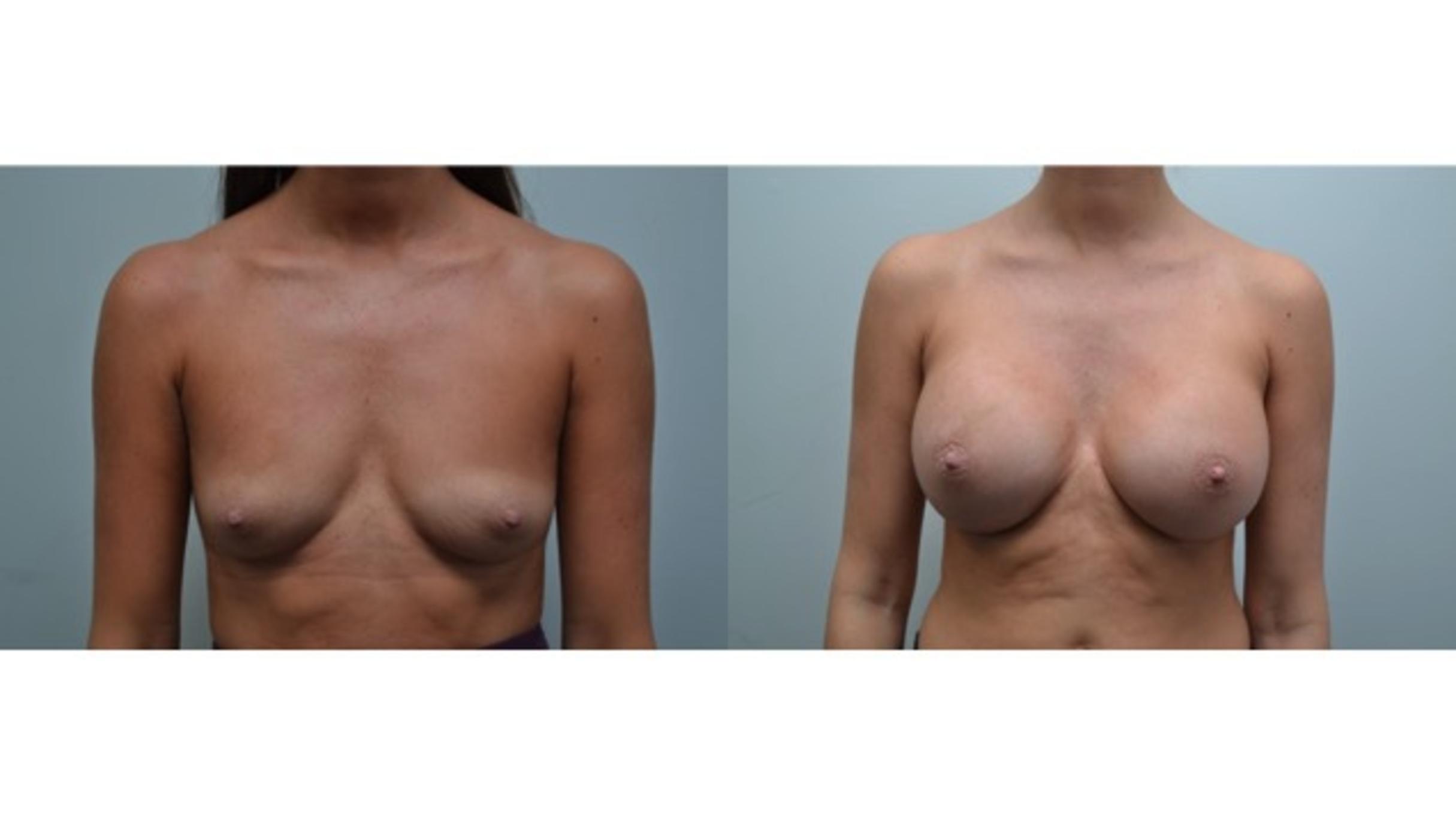 Before & After Breast Augmentation Case 279 View #1 View in Albany & Latham, New York