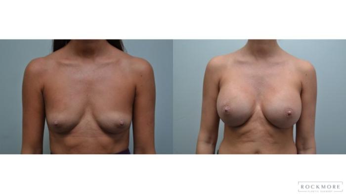 Before & After Breast Augmentation Case 279 View #1 View in Albany & Latham, New York