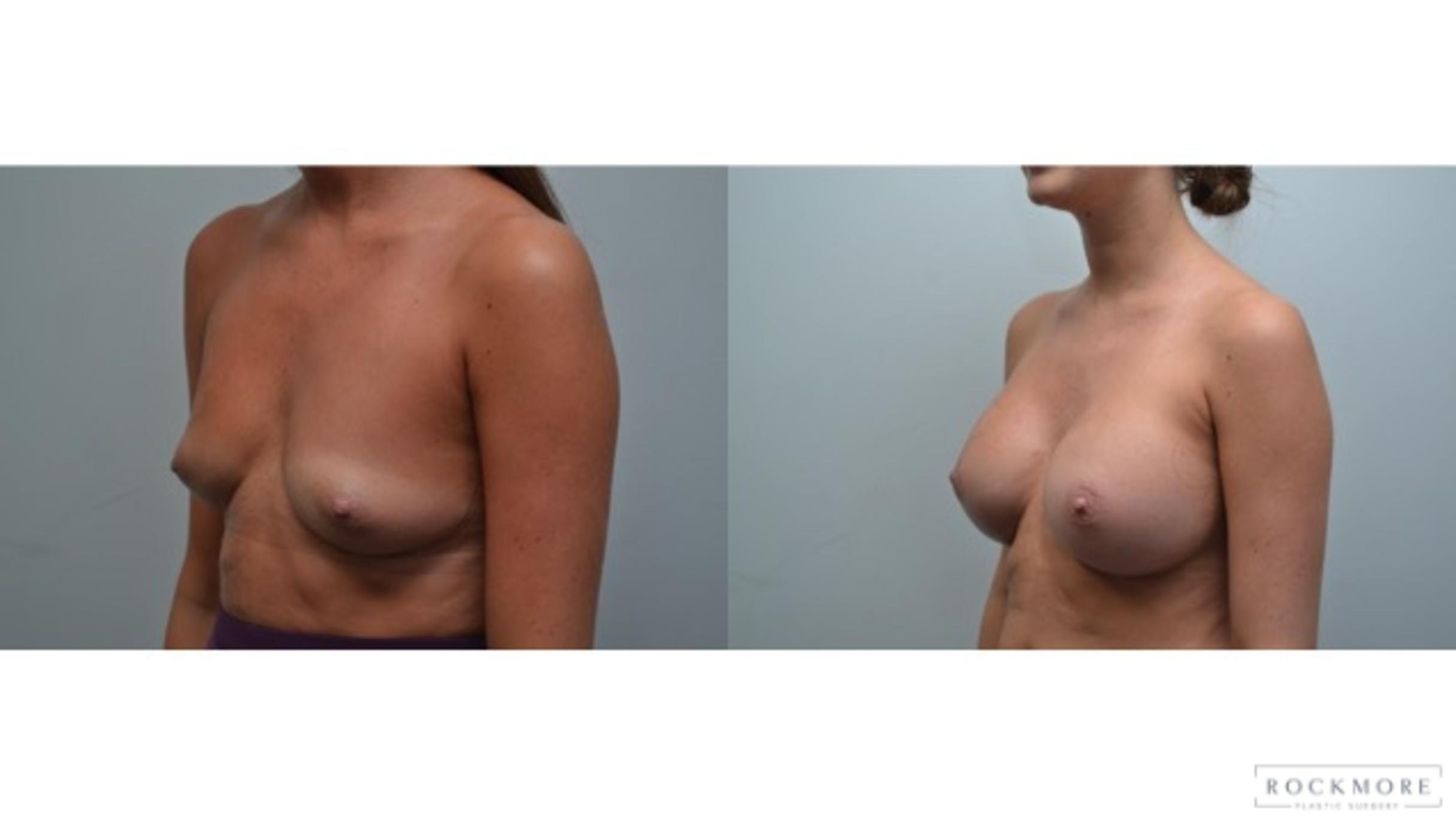 Before & After Breast Augmentation Case 279 View #2 View in Albany & Latham, New York
