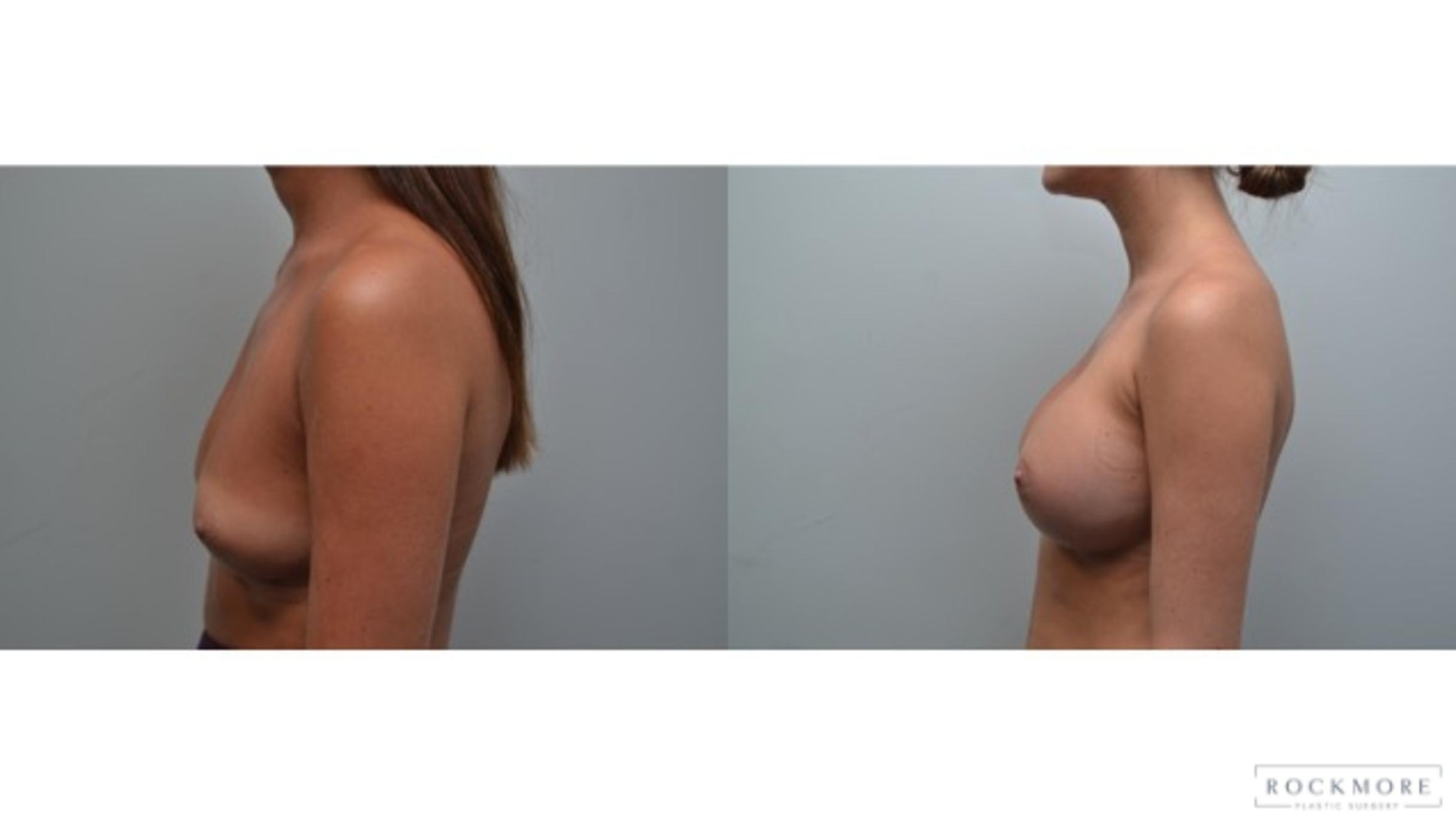 Before & After Breast Augmentation Case 279 View #3 View in Albany & Latham, New York