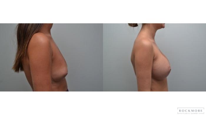 Before & After Breast Augmentation Case 279 View #4 View in Albany & Latham, New York