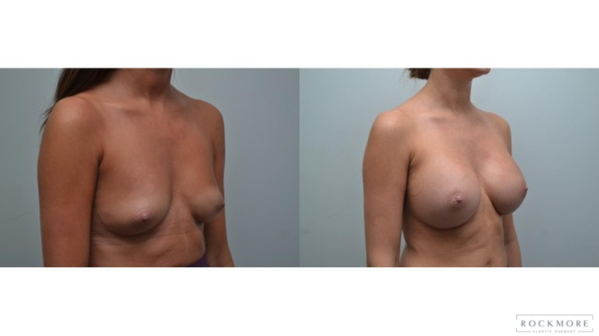 Before & After Breast Augmentation Case 279 View #5 View in Albany & Latham, New York