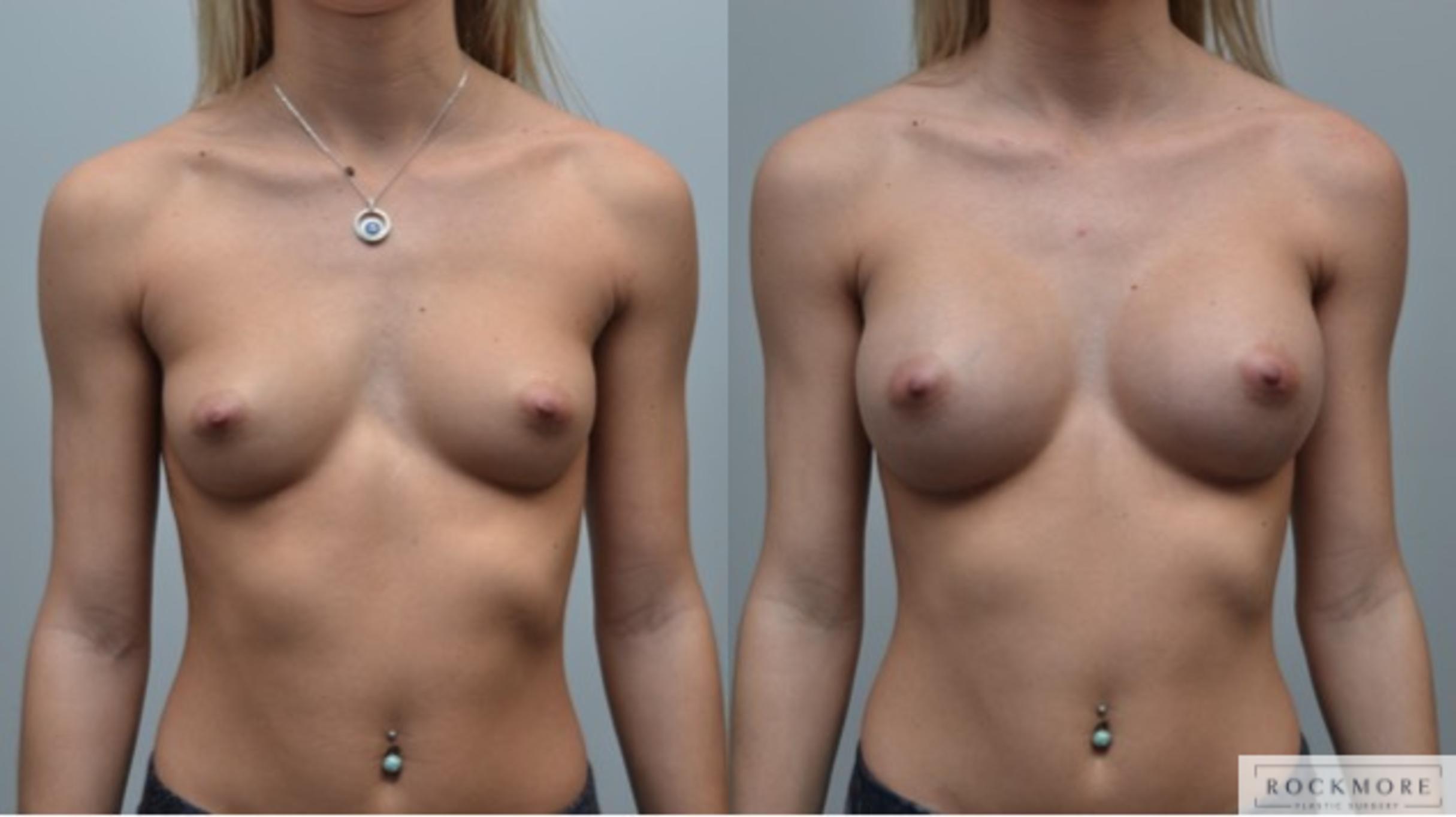 Before & After Breast Augmentation Case 283 View #1 View in Albany & Latham, New York