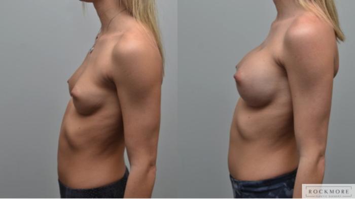 Before & After Breast Augmentation Case 283 View #2 View in Albany & Latham, New York