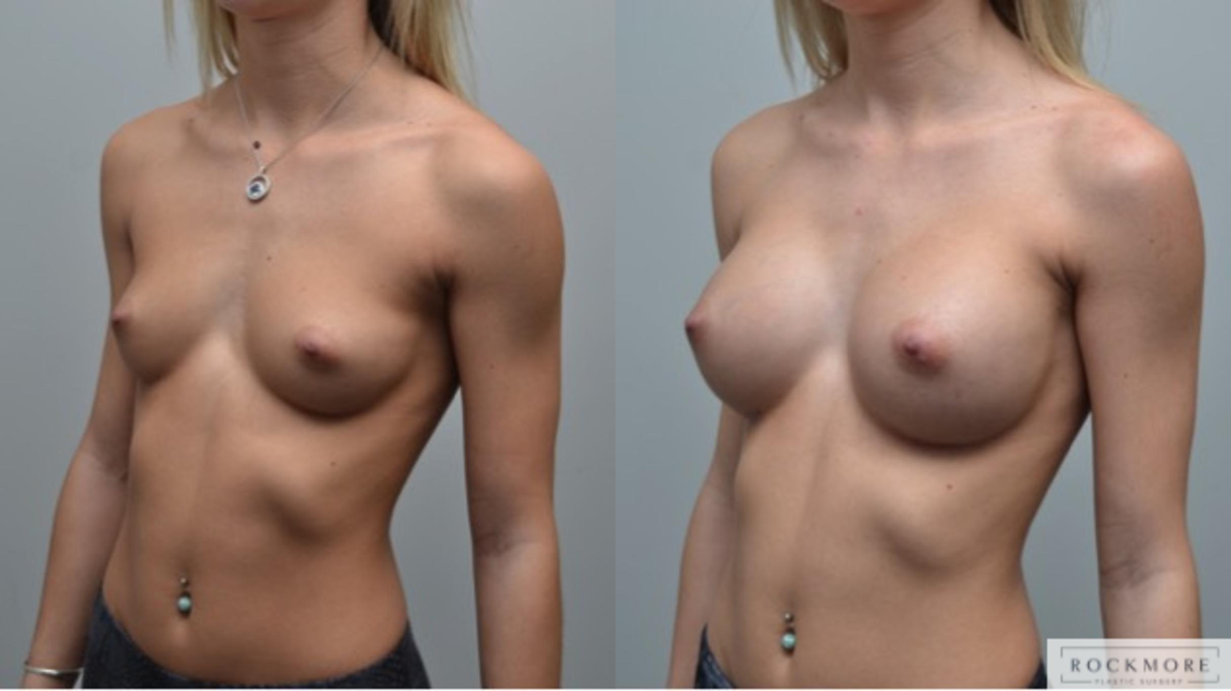 Before & After Breast Augmentation Case 283 View #3 View in Albany & Latham, New York
