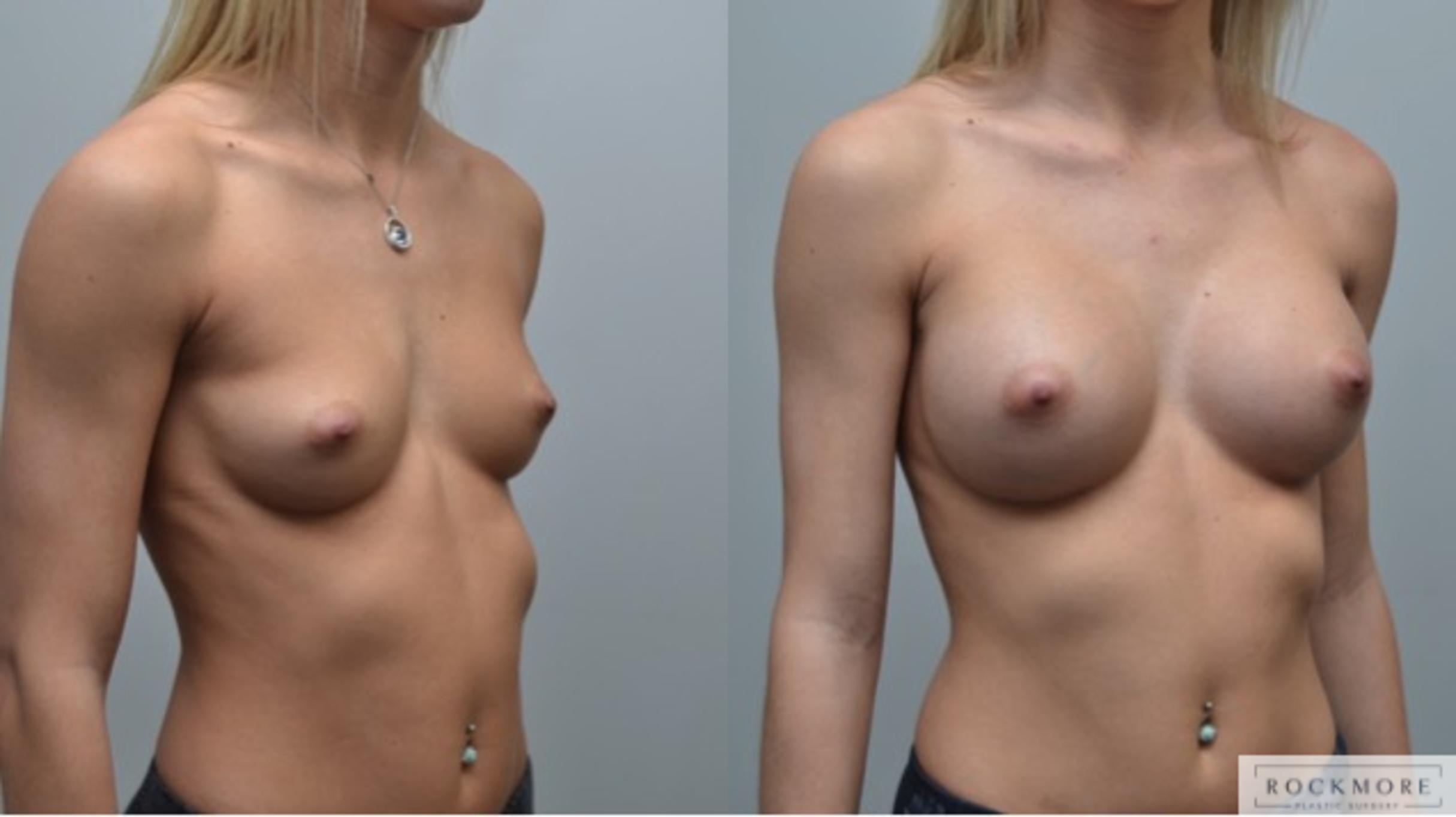 Before & After Breast Augmentation Case 283 View #4 View in Albany & Latham, New York