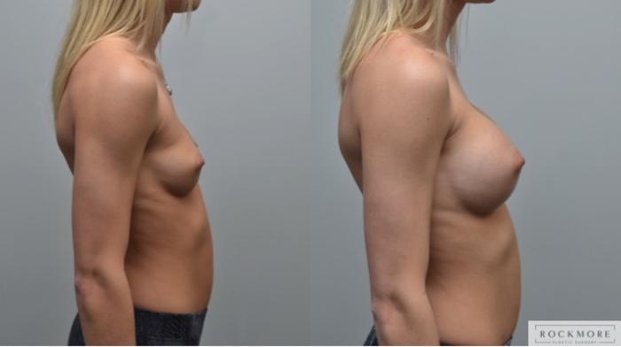 Before & After Breast Augmentation Case 283 View #5 View in Albany & Latham, New York