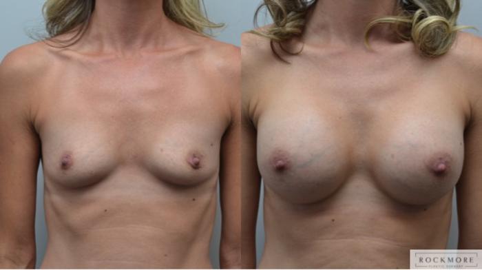 Before & After Breast Augmentation Case 284 View #1 View in Albany & Latham, New York