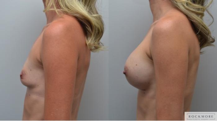 Before & After Breast Augmentation Case 284 View #2 View in Albany & Latham, New York